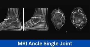 MRI Ankle Single Joint Process and Diagnosis