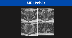 MRI Pelvis Process and Diagnosis
