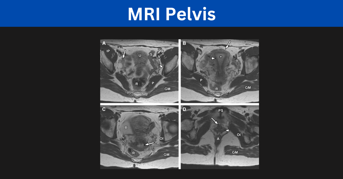 MRI Pelvis