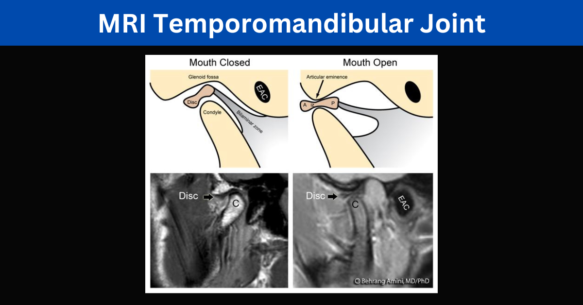 MRI temporomandibular joint