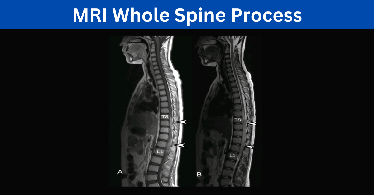 MRI Whole Spine