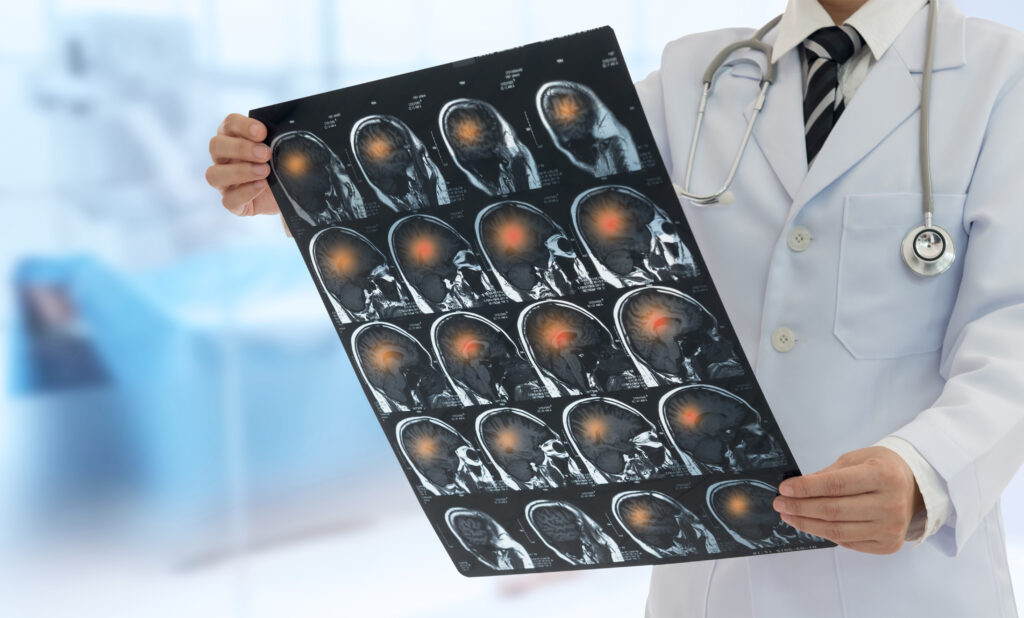 CT Angiography in Delhi